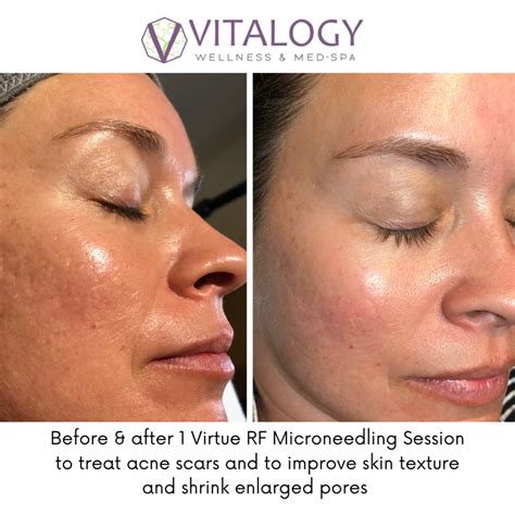 virtue rf microneedling reviews