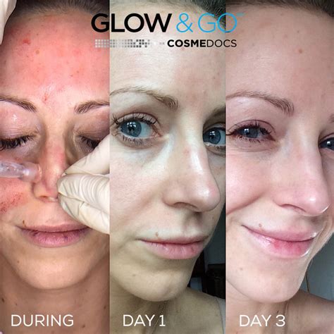 vitamin c after microneedling