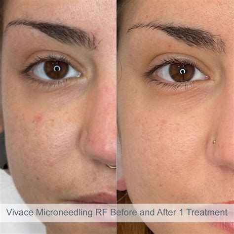 vivace microneedling before and after